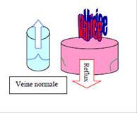 Insuffisance veineuse, une pathologie veineuse