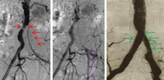 claudication-serree