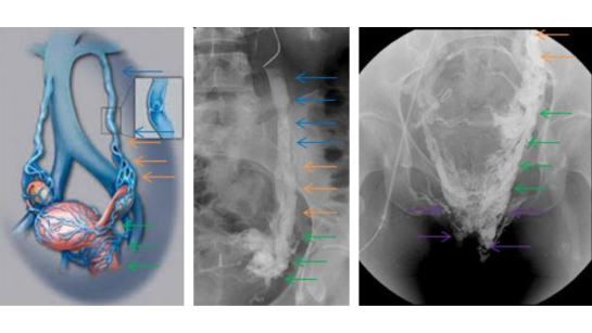 embolisation-veines-pelviennes