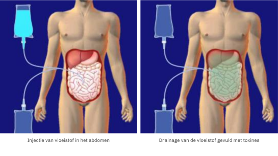 Catheter-voor-peritoneale-dialyse