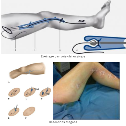 Traitement des varices par éveinage