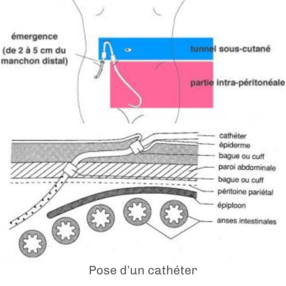 hemodialyse-pose-cathéter