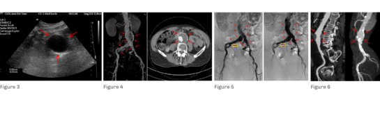 maladies-arterielles-anevrysmales-bilan