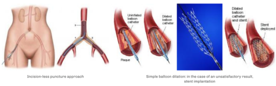 occlusive arterial diseases