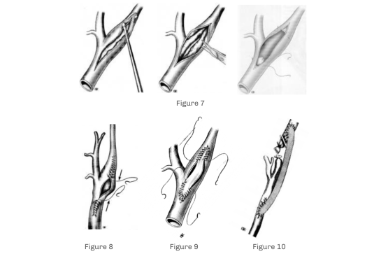 traitement-carotides